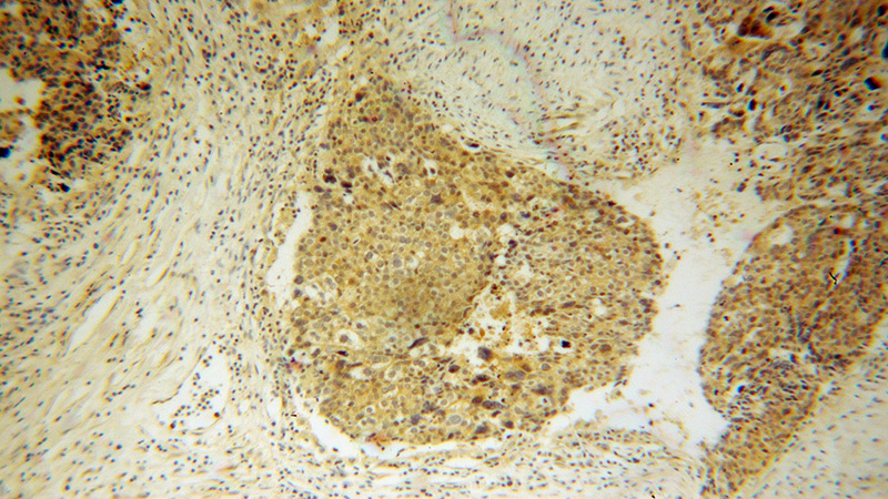Immunohistochemical of paraffin-embedded human ovary tumor using Catalog No:110651(FHL3 antibody) at dilution of 1:50 (under 10x lens)