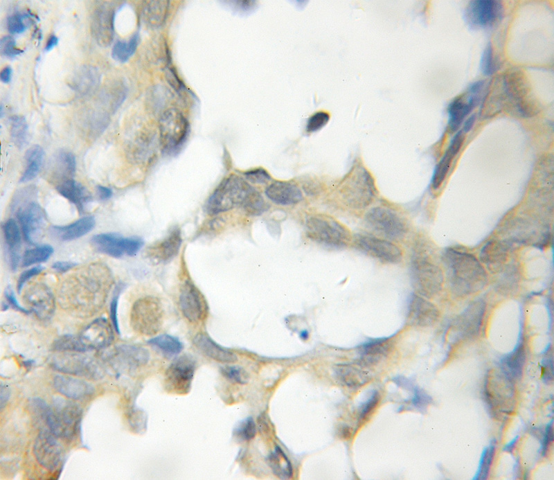 Immunohistochemical of paraffin-embedded human lung cancer using Catalog No:115694(STAT5B antibody) at dilution of 1:100 (under 10x lens)