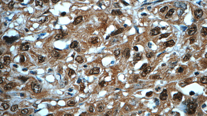 Immunohistochemistry of paraffin-embedded human cervical cancer tissue slide using Catalog No:107567(AKT Antibody) at dilution of 1:50 (under 40x lens)