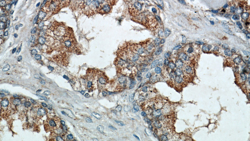 Immunohistochemical of paraffin-embedded human prostate hyperplasia using Catalog No:112197(LEPR antibody) at dilution of 1:50 (under 40x lens)