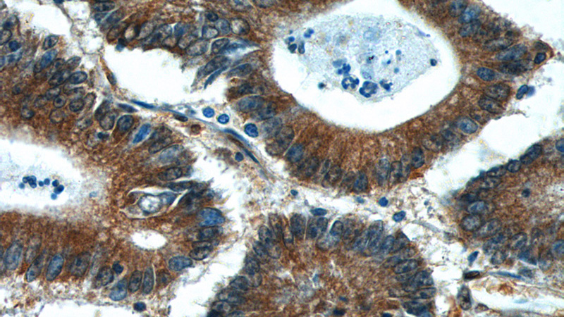 Immunohistochemistry of paraffin-embedded human colon cancer tissue slide using Catalog No:117103(BCL7B Antibody) at dilution of 1:50 (under 40x lens)