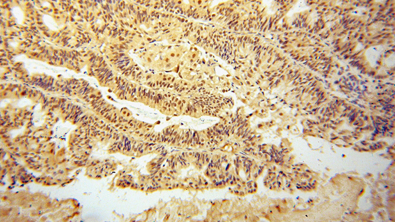 Immunohistochemical of paraffin-embedded human ovary tumor using Catalog No:113484(PAF1 antibody) at dilution of 1:100 (under 10x lens)