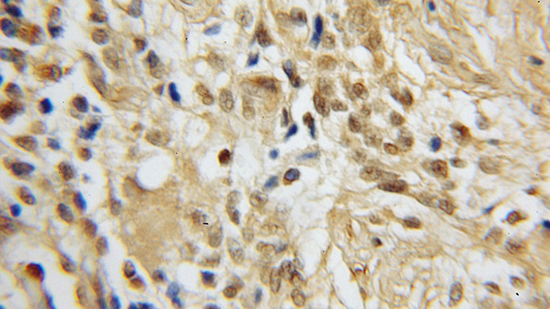 Immunohistochemical of paraffin-embedded human gliomas using Catalog No:116003(TFAP4 antibody) at dilution of 1:50 (under 10x lens)