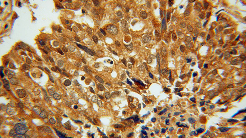 Immunohistochemical of paraffin-embedded human ovary tumor using Catalog No:113398(NUTF2 antibody) at dilution of 1:100 (under 40x lens)