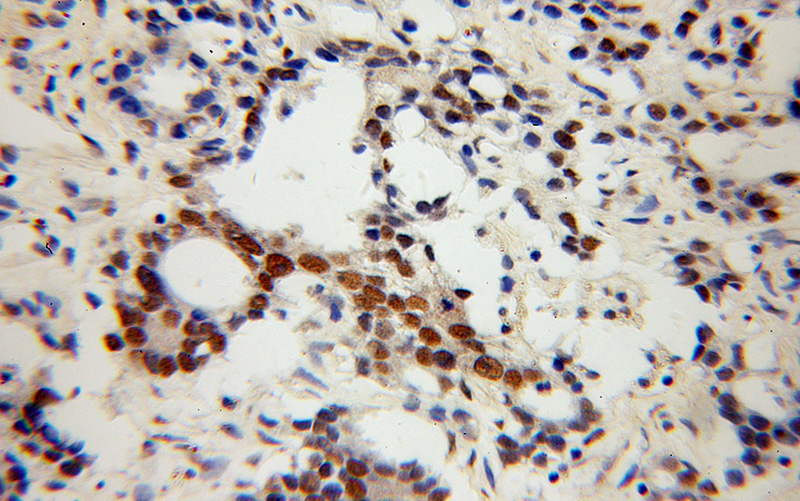 Immunohistochemical of paraffin-embedded human gliomas using Catalog No:113453(NXF3 antibody) at dilution of 1:50 (under 40x lens)
