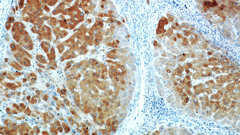 Immunohistochemical of paraffin-embedded human hepatocirrhosis using Catalog No:115057(SAMM50 antibody) at dilution of 1:100 (under 10x lens)