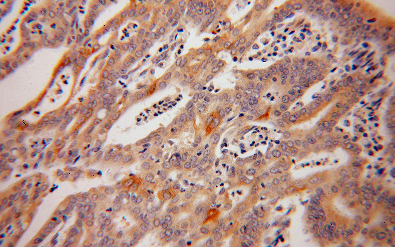 Immunohistochemical of paraffin-embedded human endometrial cancer using Catalog No:108871(CASP10 antibody) at dilution of 1:100 (under 40x lens)