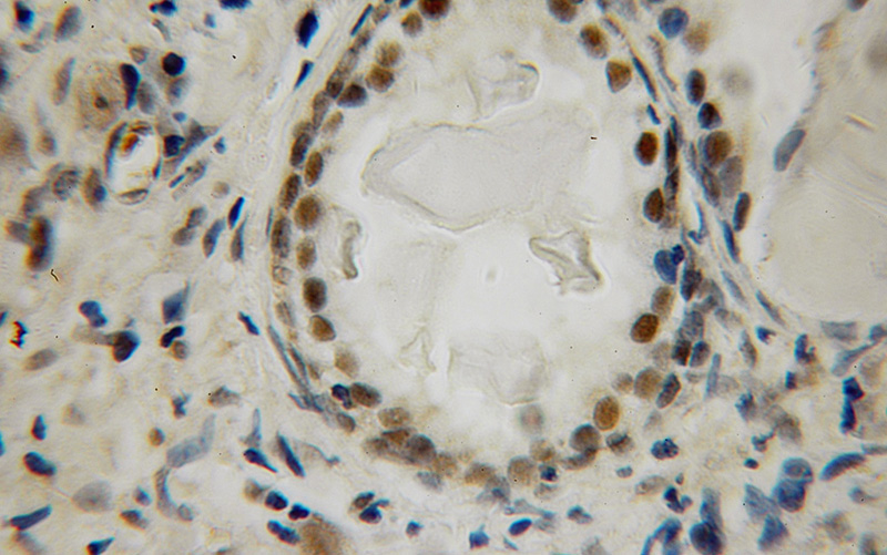 Immunohistochemical of paraffin-embedded human prostate cancer using Catalog No:112222(LIG4 antibody) at dilution of 1:100 (under 10x lens)