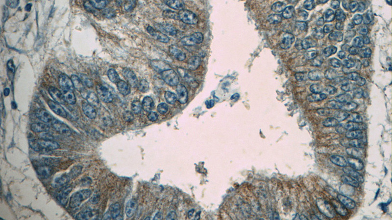Immunohistochemistry of paraffin-embedded human colon cancer tissue slide using Catalog No:112614(MDK Antibody) at dilution of 1:50 (under 40x lens)