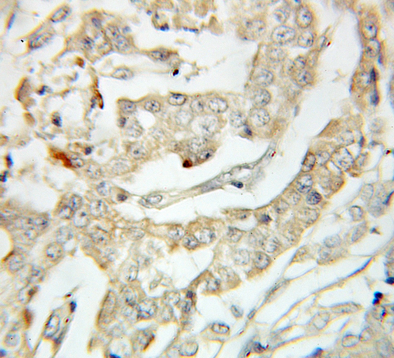 Immunohistochemical of paraffin-embedded human pancreas cancer using Catalog No:111628(IFNGR1 antibody) at dilution of 1:100 (under 10x lens)