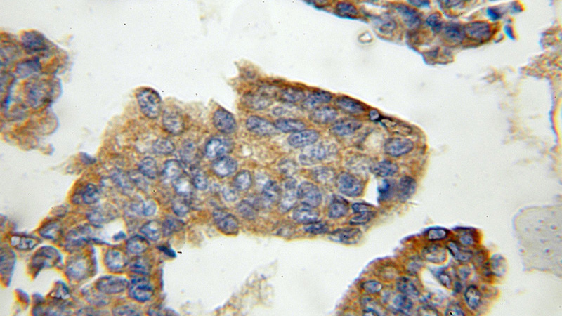 Immunohistochemical of paraffin-embedded human breast cancer using Catalog No:109566(CRLS1 antibody) at dilution of 1:100 (under 10x lens)