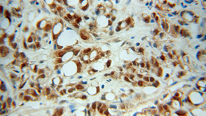 Immunohistochemical of paraffin-embedded human prostate cancer using Catalog No:111874(INTS5 antibody) at dilution of 1:100 (under 40x lens)