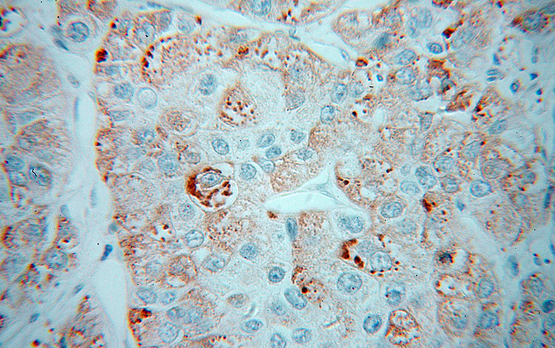 Immunohistochemical of paraffin-embedded human liver cancer using Catalog No:109514(CPN1 antibody) at dilution of 1:100 (under 40x lens)