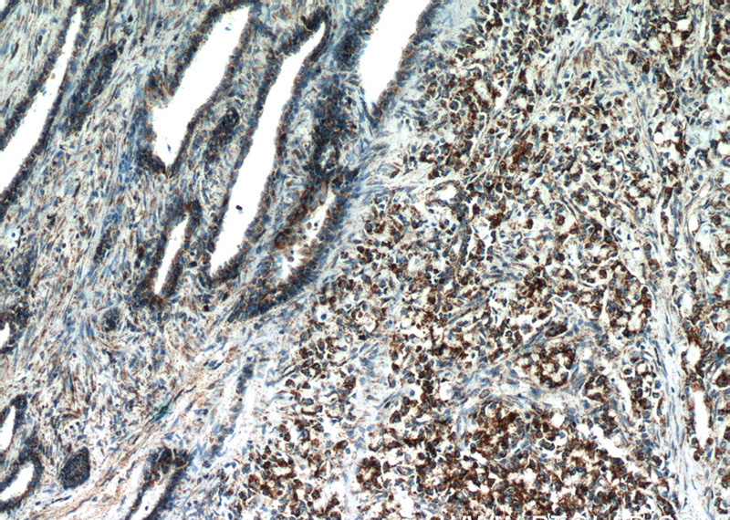 Immunohistochemistry of paraffin-embedded human prostate cancer slide using Catalog No:112312(LPXN Antibody) at dilution of 1:50. (under 10x lens)
