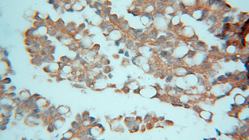 Immunohistochemical of paraffin-embedded human ovary tumor using Catalog No:117068(ATXN10 antibody) at dilution of 1:100 (under 40x lens)