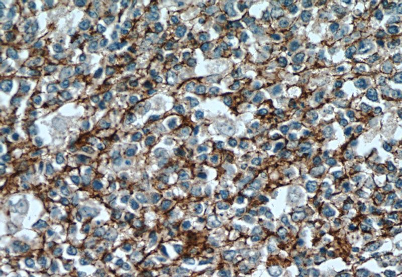 Immunohistochemical of paraffin-embedded human tonsillitis using Catalog No:109140(CD81 antibody) at dilution of 1:100 (under 40x lens)