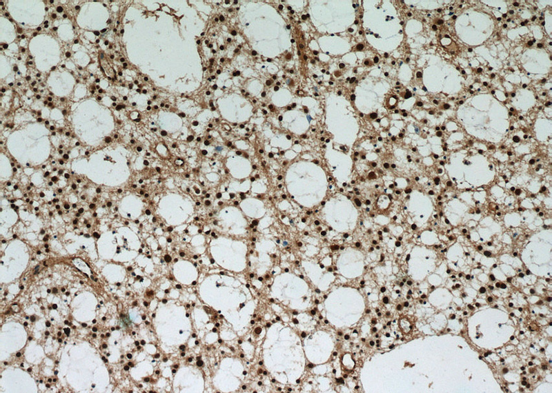 Immunohistochemical of paraffin-embedded human gliomas using Catalog No:116726(VCP antibody) at dilution of 1:50 (under 10x lens)