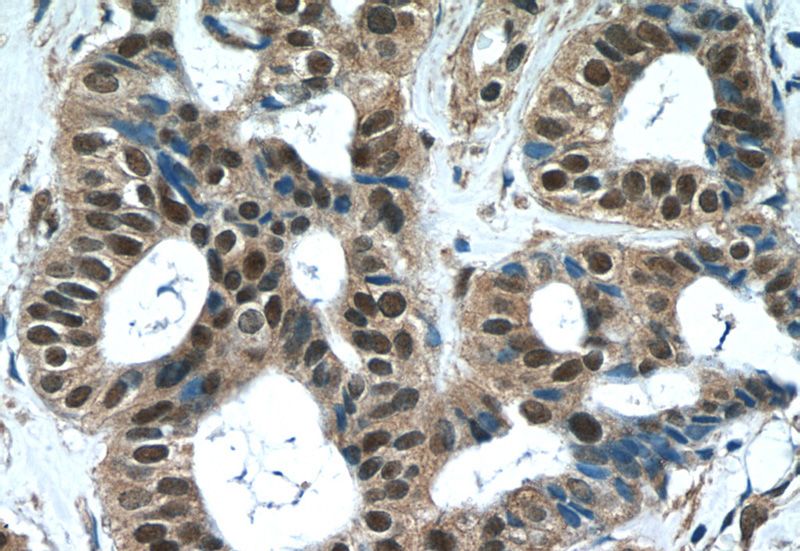 Immunohistochemistry of paraffin-embedded human breast cancer tissue slide using Catalog No:116865(WDR38 Antibody) at dilution of 1:50 (under 40x lens)