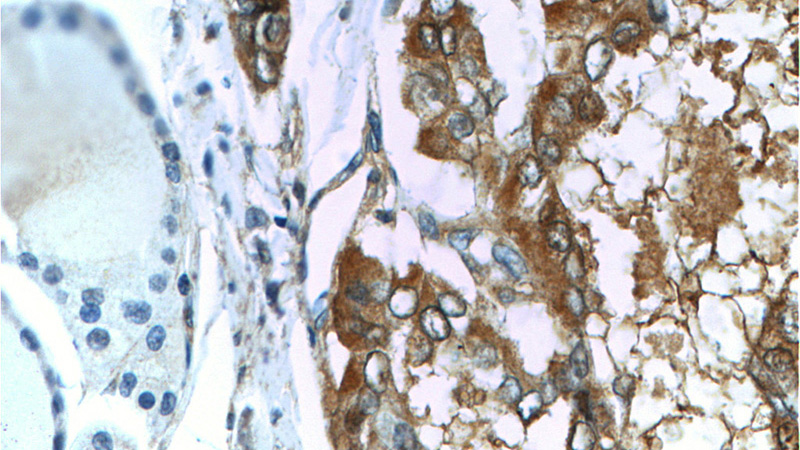 Immunohistochemistry of paraffin-embedded human thyroid cancer tissue slide using Catalog No:107286(Galectin 3 Antibody) at dilution of 1:100 (under 40x lens)