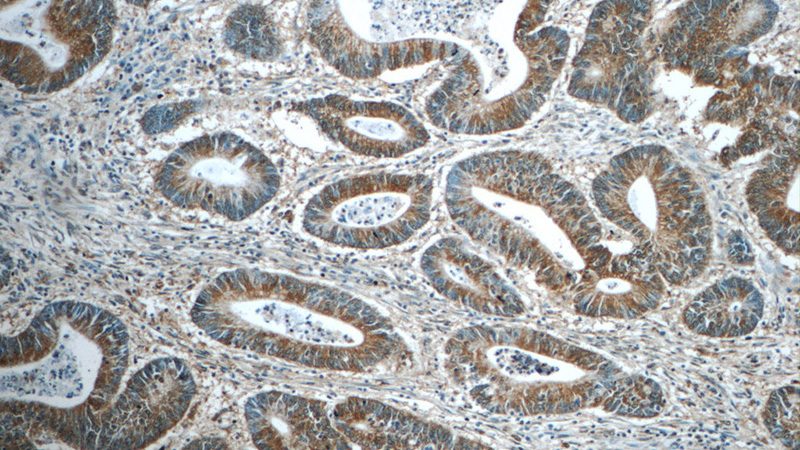 Immunohistochemistry of paraffin-embedded human colon cancer tissue slide using Catalog No:109273(CHPF Antibody) at dilution of 1:50 (under 10x lens)