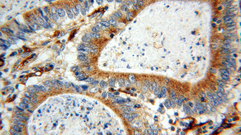 Immunohistochemical of paraffin-embedded human colon cancer using Catalog No:108307(ATP6V1B2 antibody) at dilution of 1:100 (under 40x lens)