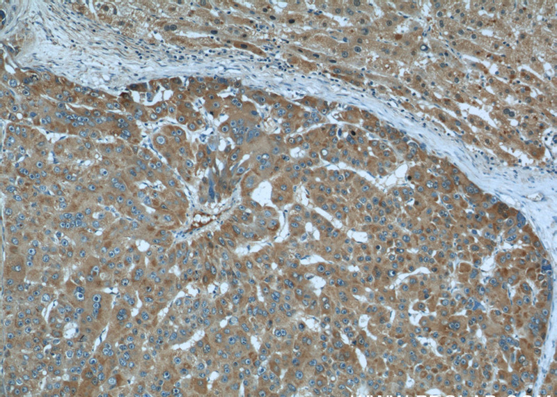 Immunohistochemical of paraffin-embedded human liver cancer using Catalog No:107206(AHSG antibody) at dilution of 1:200 (under 10x lens)