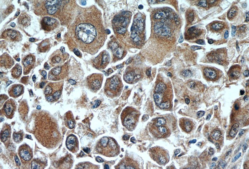 Immunohistochemistry of paraffin-embedded human liver cancer tissue slide using Catalog No:110059(DDC Antibody) at dilution of 1:50 (under 40x lens)