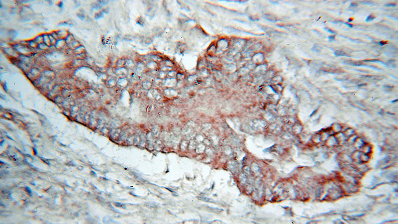 Immunohistochemical of paraffin-embedded human colon cancer using Catalog No:113680(PDHX antibody) at dilution of 1:100 (under 40x lens)