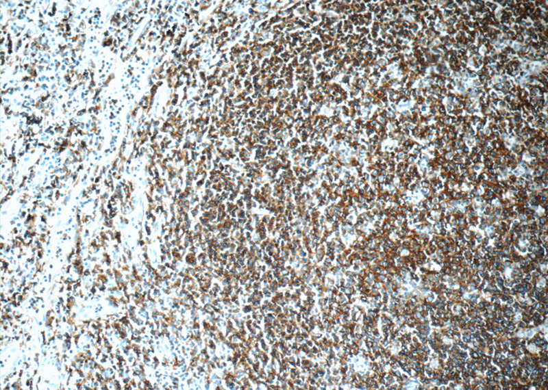 Immunohistochemistry of paraffin-embedded human tonsillitis slide using Catalog No:109005(MS4A1,CD20 Antibody) at dilution of 1:50