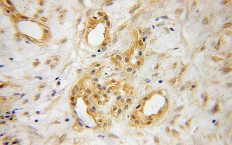 Immunohistochemical of paraffin-embedded human pancreas cancer using Catalog No:114594(RBBP9 antibody) at dilution of 1:50 (under 10x lens)