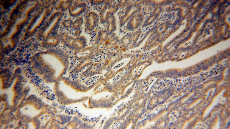 Immunohistochemical of paraffin-embedded human endometrial cancer using Catalog No:108871(CASP10 antibody) at dilution of 1:100 (under 10x lens)
