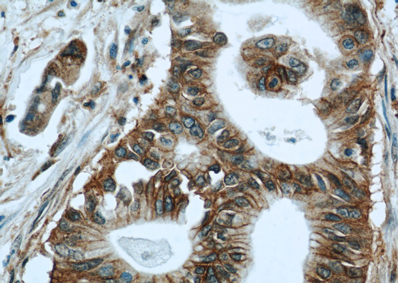 Immunohistochemical of paraffin-embedded human pancreas cancer using Catalog No:112121(KRAS-2B-speicifc antibody) at dilution of 1:50 (under 40x lens)