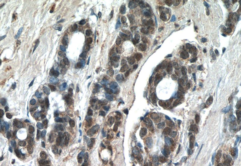 Immunohistochemistry of paraffin-embedded human cervical cancer tissue slide using Catalog No:111899(JUN Antibody) at dilution of 1:50 (under 40x lens)