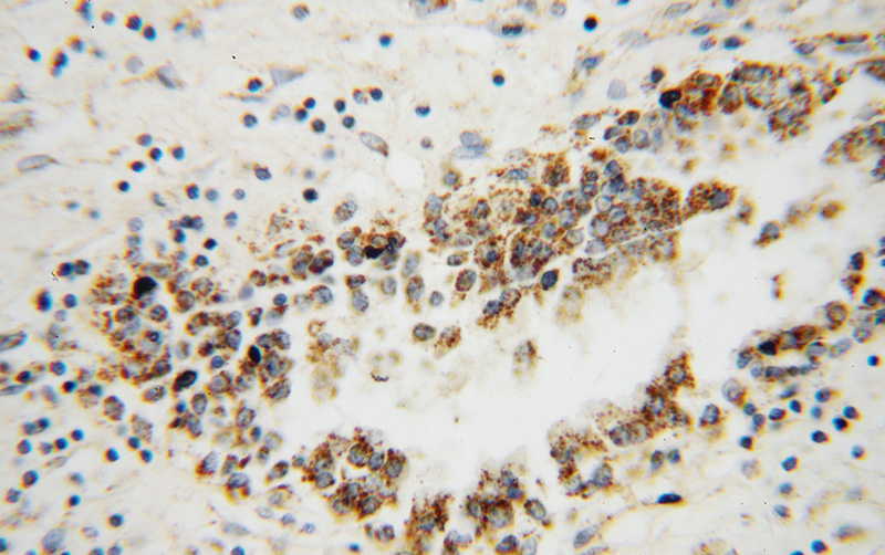Immunohistochemical of paraffin-embedded human prostate cancer using Catalog No:111555(HSDL2 antibody) at dilution of 1:100 (under 40x lens)