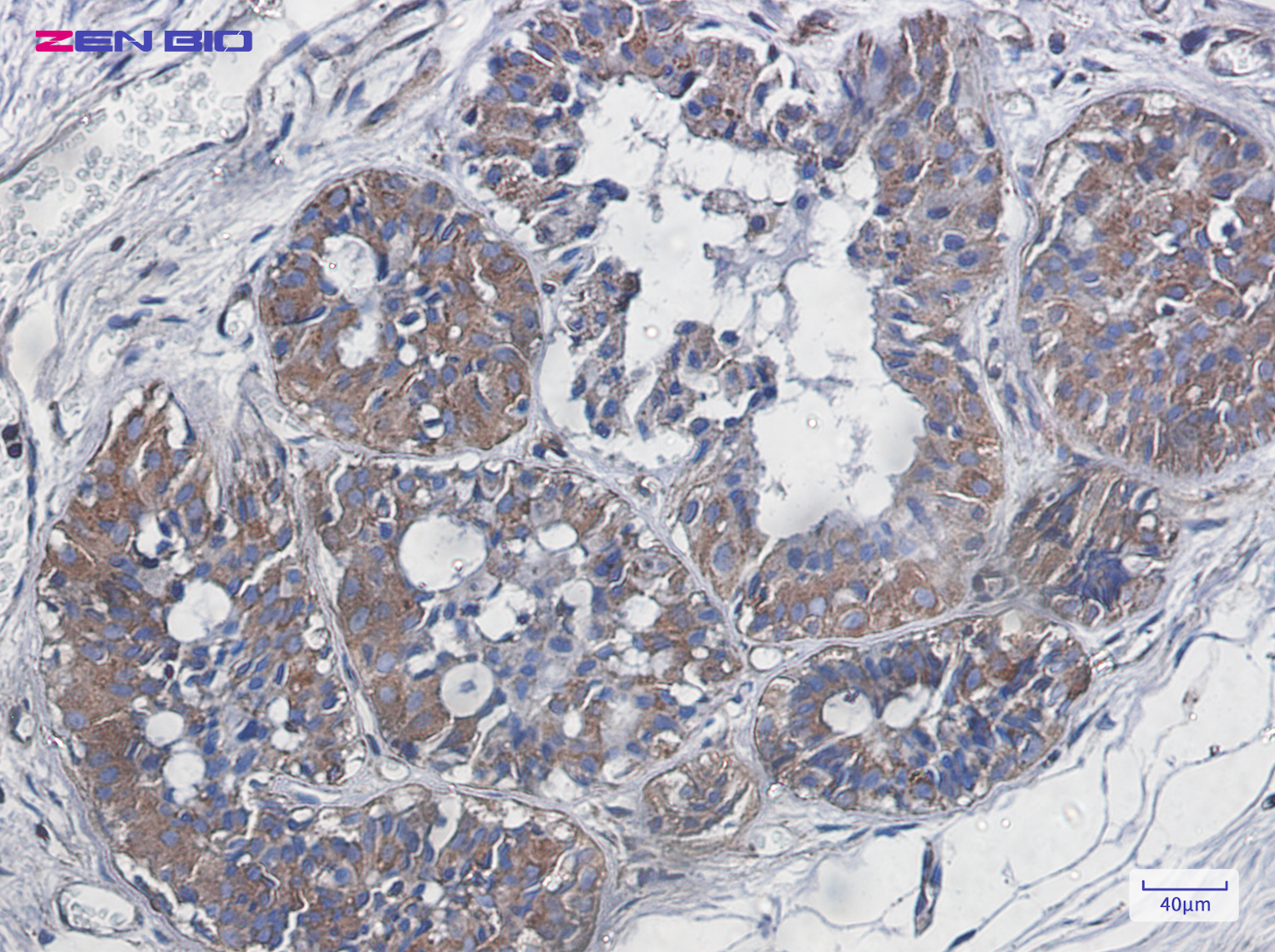 Immunohistochemistry of NF-kB p65 in paraffin-embedded Human breast cancer tissue using NF-kB p65 Rabbit pAb at dilution 1/20
