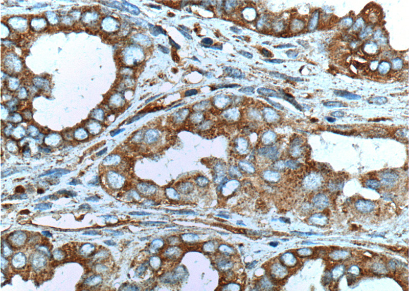 Immunohistochemistry of paraffin-embedded human ovary tumor tissue slide using Catalog No:112889(MUC16,CA125 Antibody) at dilution of 1:200 (under 40x lens). heat mediated antigen retrieved with Tris-EDTA buffer(pH9).