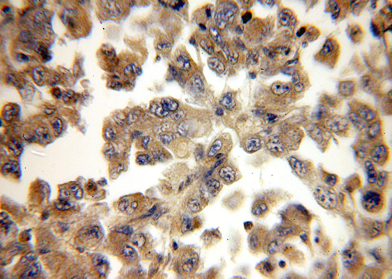 Immunohistochemical of paraffin-embedded human lung cancer using Catalog No:110447(FADD antibody) at dilution of 1:50 (under 40x lens)