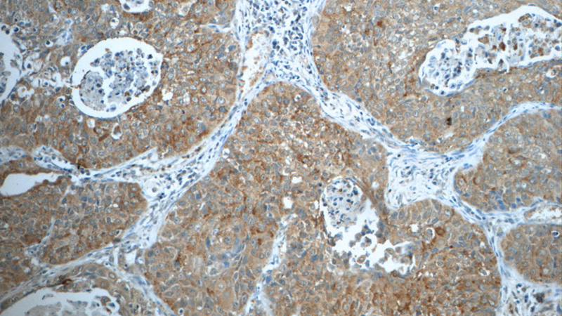 Immunohistochemistry of paraffin-embedded human lung cancer tissue slide using Catalog No:111834(IRF2BP2 Antibody) at dilution of 1:50