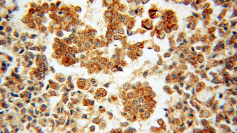Immunohistochemical of paraffin-embedded human breast cancer using Catalog No:108247(ARF5 antibody) at dilution of 1:50 (under 40x lens)