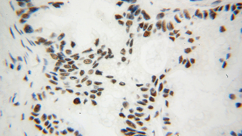 Immunohistochemical of paraffin-embedded human pancreas cancer using Catalog No:108105(ANP32B antibody) at dilution of 1:100 (under 40x lens)