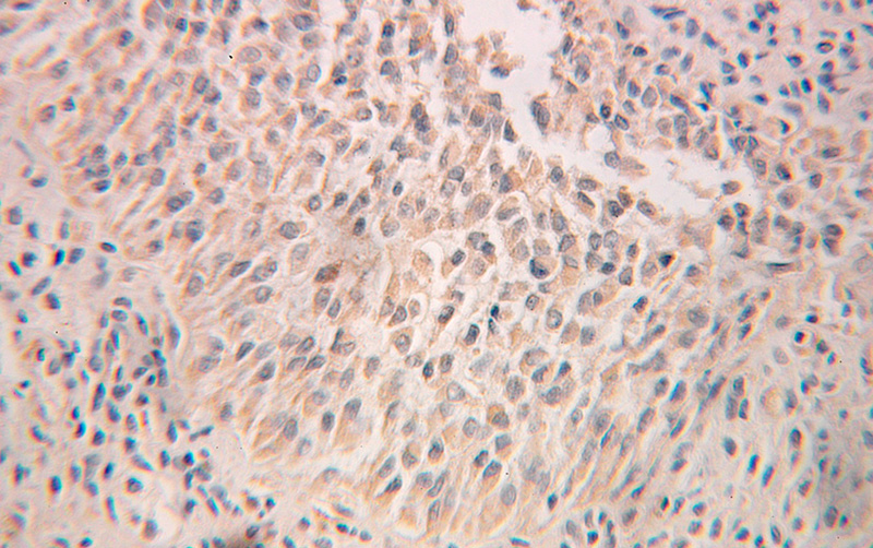 Immunohistochemical of paraffin-embedded human ovary tumor using Catalog No:114820(RPN2 antibody) at dilution of 1:100 (under 25x lens)