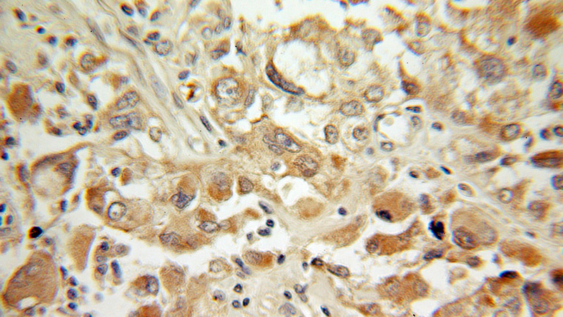 Immunohistochemical of paraffin-embedded human ovary tumor using Catalog No:114975(SAT1 antibody) at dilution of 1:100 (under 10x lens)