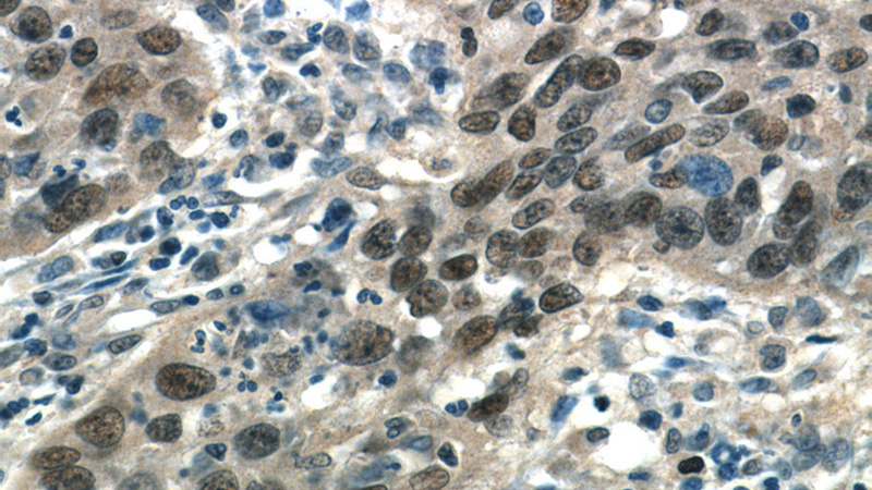 Immunohistochemistry of paraffin-embedded human cervical cancer tissue slide using Catalog No:108113(AP1,JUN,P39 Antibody) at dilution of 1:50 (under 40x lens)