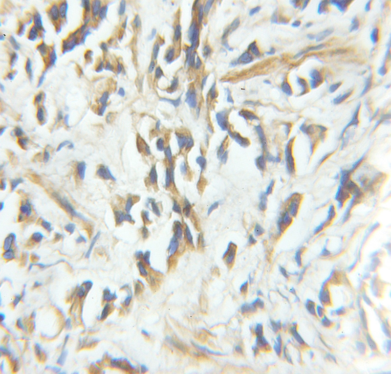 Immunohistochemical of paraffin-embedded human prostate cancer using Catalog No:109428(CNN3 antibody) at dilution of 1:100 (under 10x lens)