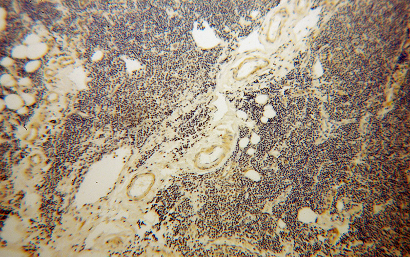 Immunohistochemical of paraffin-embedded human lymphoma using Catalog No:115811(STXBP3 antibody) at dilution of 1:100 (under 10x lens)