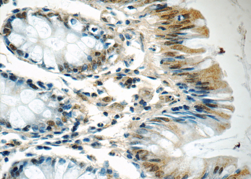 Immunohistochemistry of paraffin-embedded human colon tissue slide using Catalog No:113637(PDS5A Antibody) at dilution of 1:50 (under 40x lens)