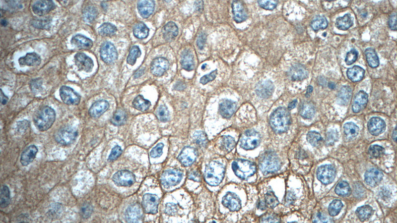 Immunohistochemistry of paraffin-embedded human breast cancer tissue slide using Catalog No:116174(TMEM199 Antibody) at dilution of 1:50 (under 40x lens)