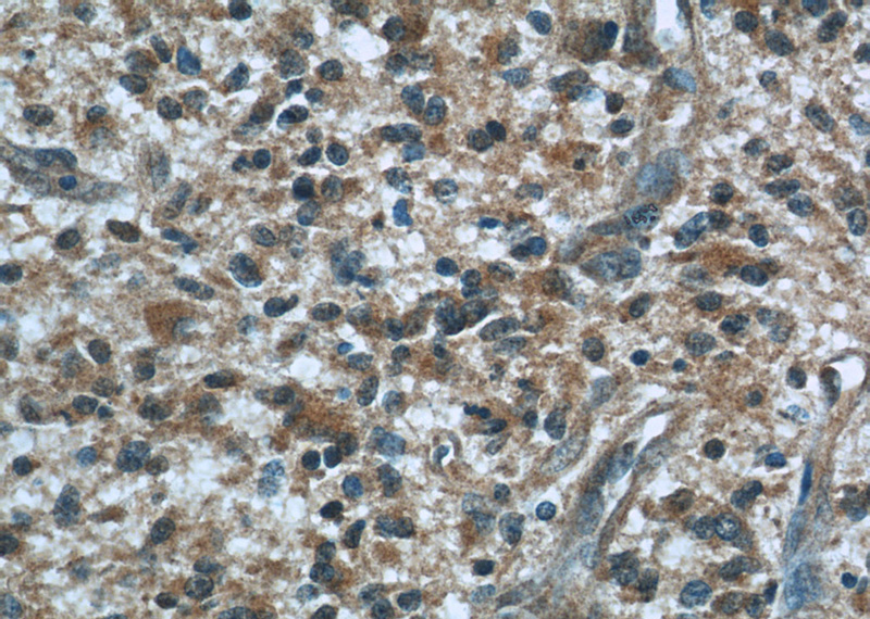 Immunohistochemical of paraffin-embedded human gliomas using Catalog No:107083(BCS1L antibody) at dilution of 1:50 (under 40x lens)