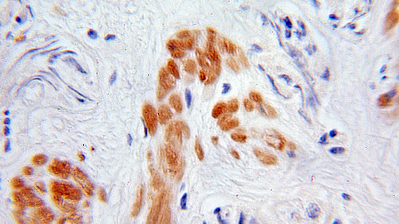 Immunohistochemical of paraffin-embedded human prostate cancer using Catalog No:115976(TADA3L antibody) at dilution of 1:100 (under 10x lens)