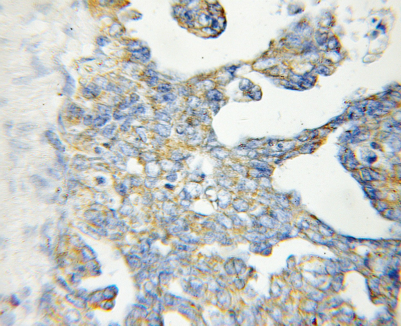 Immunohistochemical of paraffin-embedded human ovary tumor using Catalog No:110647(FH antibody) at dilution of 1:50 (under 40x lens)